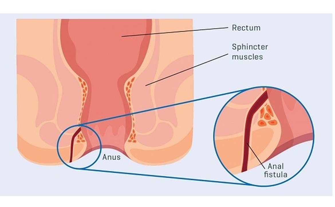 Fissure And Fistula in Ano