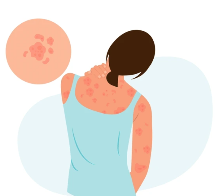 ALLERGIC DERMATITIS & SKIN DISEASES